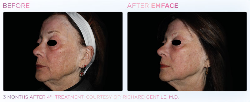 Before & After Image Treatment | EMFACE | Image Gallery | Carroll Dermatology