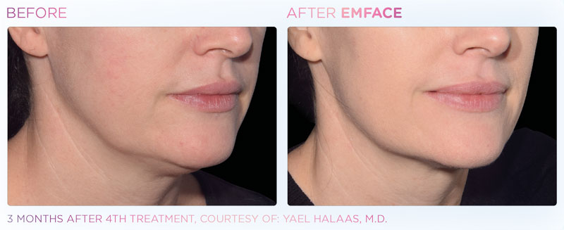 Before & After Image Treatment | EMFACE | Image Gallery | Carroll Dermatology