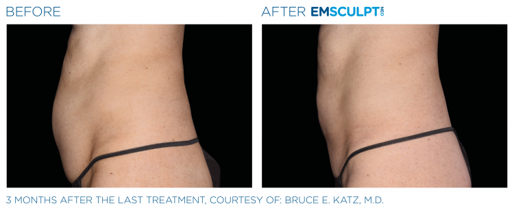 Before & After Image Treatment | EMSCULPT NEO | Image Gallery | Carroll Dermatology