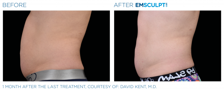 Before & After Image Treatment | EMSCULPT NEO | Image Gallery | Carroll Dermatology