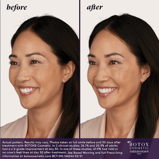 Before & After Image Treatment | BOTOX® | Image Gallery | Carroll Dermatology