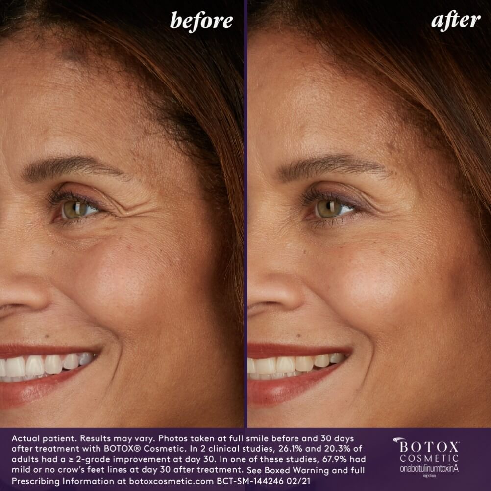 Before & After Image Treatment | BOTOX® | Image Gallery | Carroll Dermatology