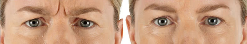 Before & After Image Treatment | Xeomin® | Image Gallery | Carroll Dermatology