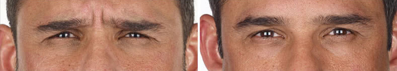 Before & After Image Treatment | Xeomin® | Image Gallery | Carroll Dermatology