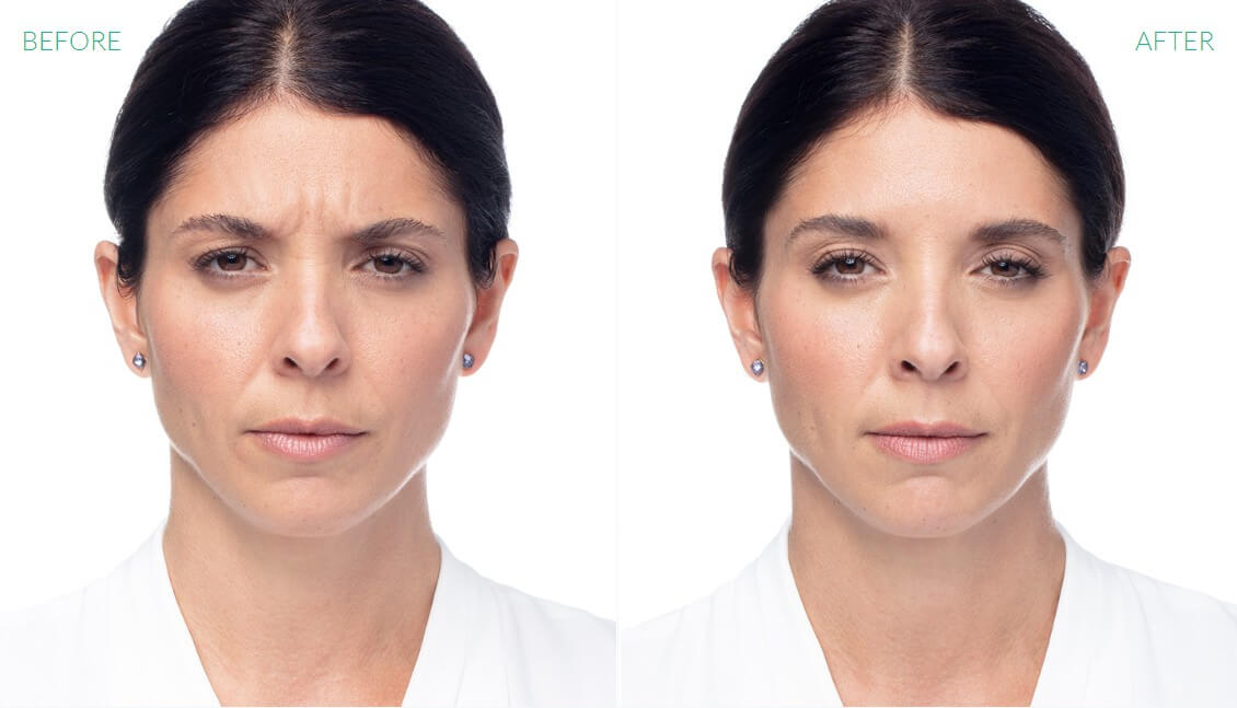 Before & After Image Treatment | Dysport® | Image Gallery | Carroll Dermatology