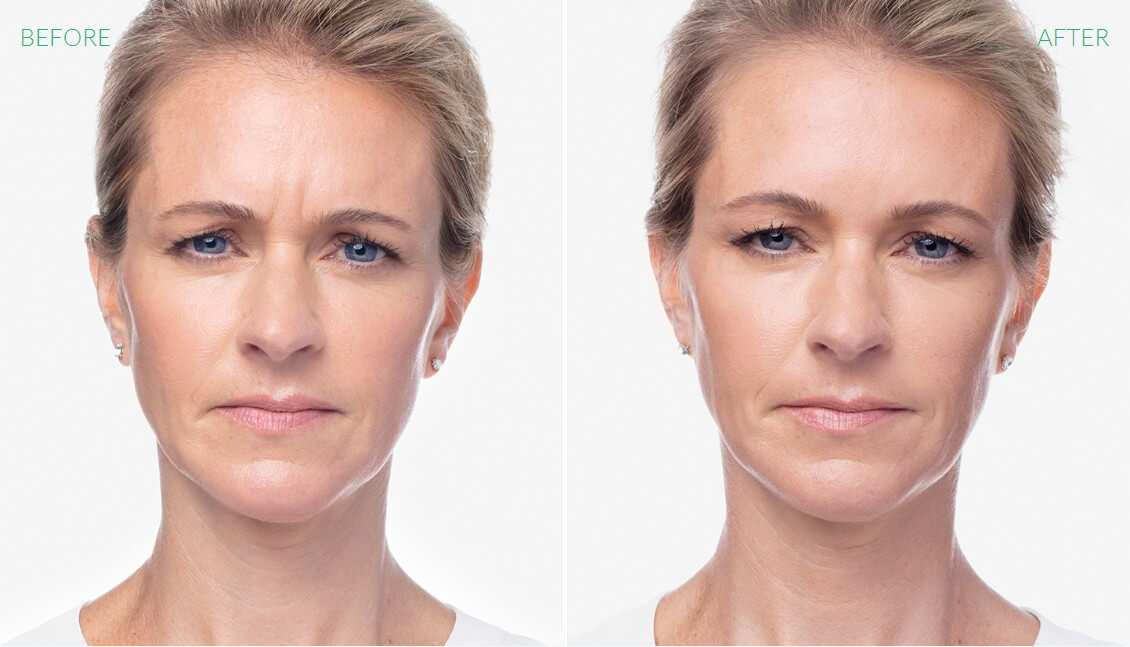 Before & After Image Treatment | Dysport® | Image Gallery | Carroll Dermatology