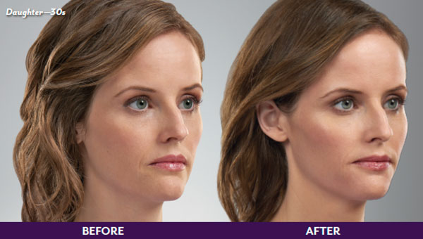 Before & After Image Treatment | JUVÉDERM | Image Gallery | Carroll Dermatology