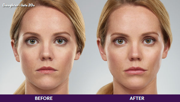 Before & After Image Treatment | JUVÉDERM | Image Gallery | Carroll Dermatology