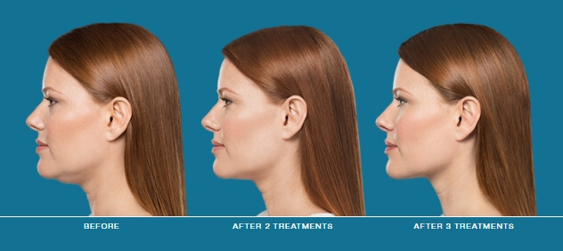 Before & After Image Treatment | KYBELLA® | Image Gallery | Carroll Dermatology