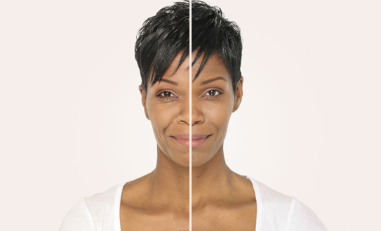 Before & After Image Treatment | RADIESSE® | Image Gallery | Carroll Dermatology