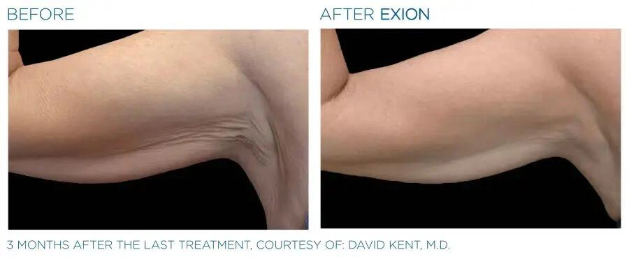 EXION Body Before and After | Carroll Dermatology