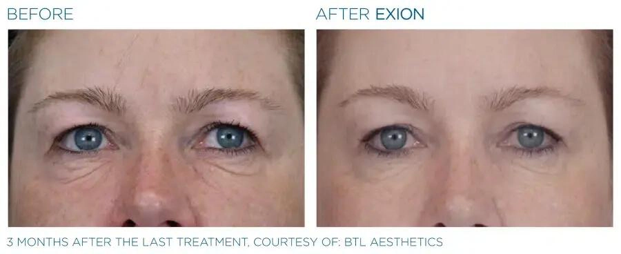 EXION Face Before and After | Carroll Dermatology