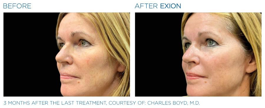 EXION RF Microneedling Before and After | Carroll Dermatology